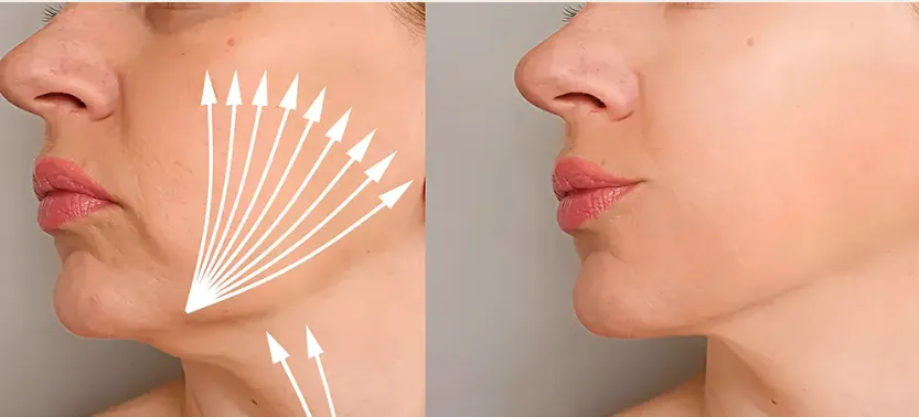 Eliminar la papada sin cirugía en Málaga: El secreto para un perfil más definido ✨